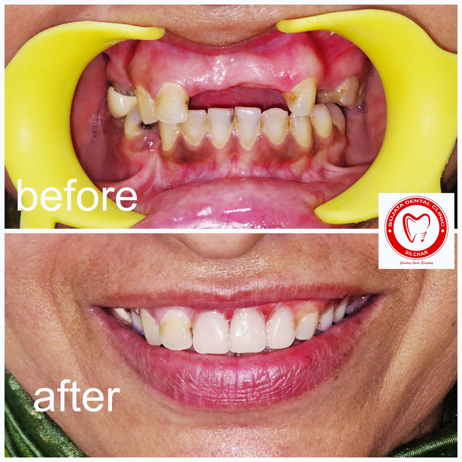 Smile transformation 6